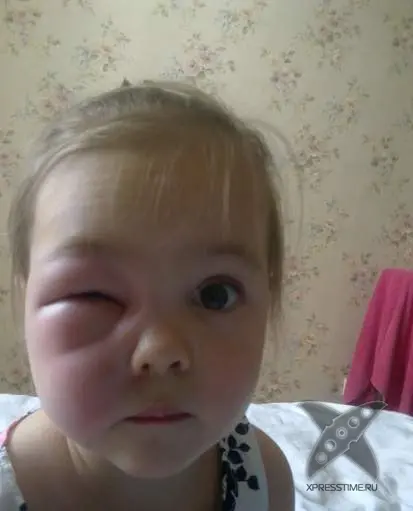 Последствия укуса пчелы
