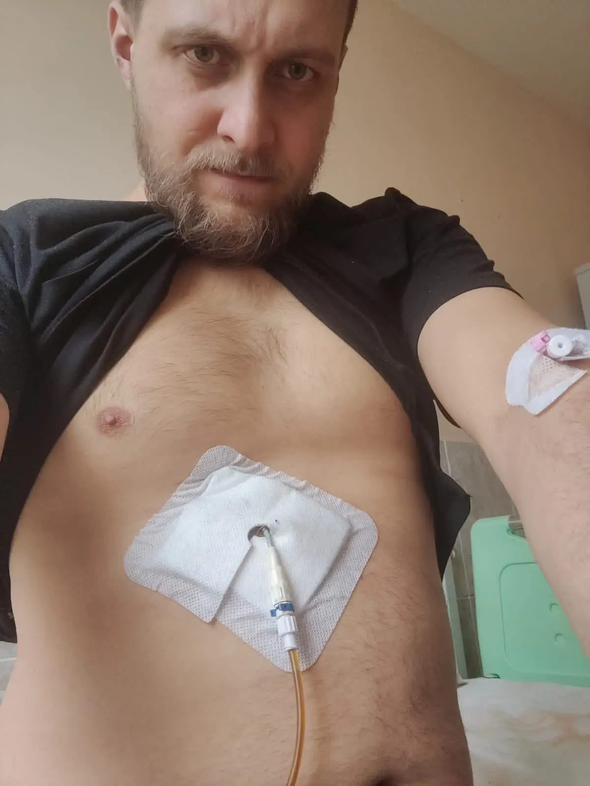 Вот по этой трубке через дырку в животе желчь выходила в специальный мешок
